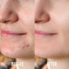 DermaClear LED Anti-Acne Device
