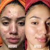 DermaClear LED Anti-Acne Device