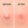 Anti-Blemish Patches