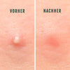 Vorher-Nachher Vergleich mit Silky Planet Anti-Pickel Pflaster – sichtbare Reduktion von Rötung, Schwellung und unangenehmen Pickeln.