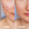 Vorher-Nachher Vergleich – Haut vor und nach Anwendung des Silky Planet DermaClear Geräts zur Aknebehandlung.