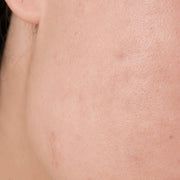 Akne after