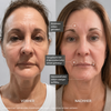 Sanftes Micro Infusion Treatment als moderne Microneedling Alternative