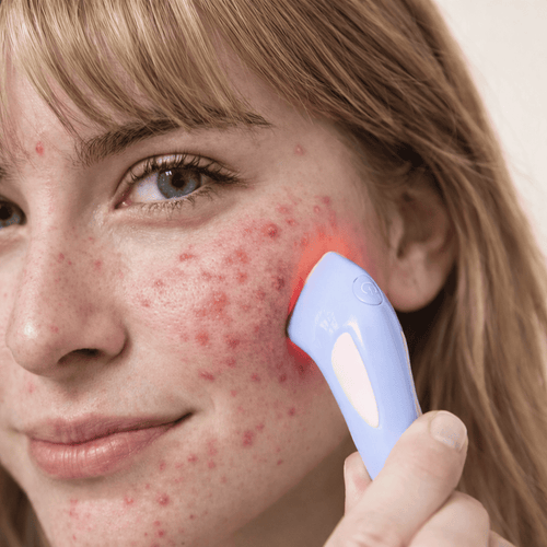 Lichttherapie & Akne-Gerät DermaClear
