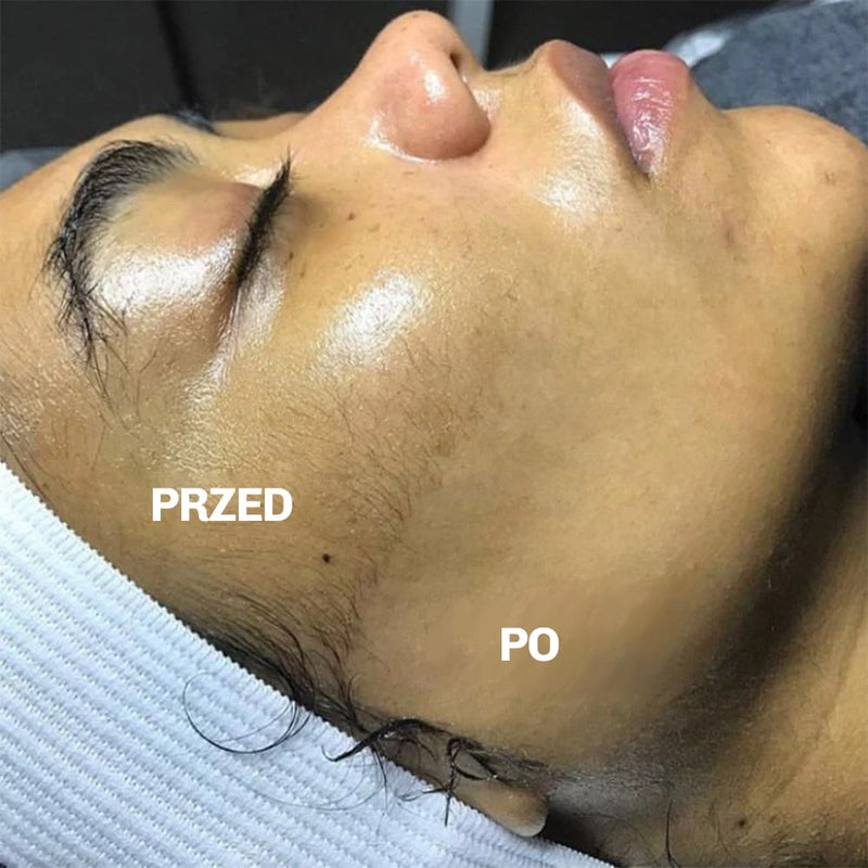 Dermaplaning odpowiedni dla wrazliwej skory