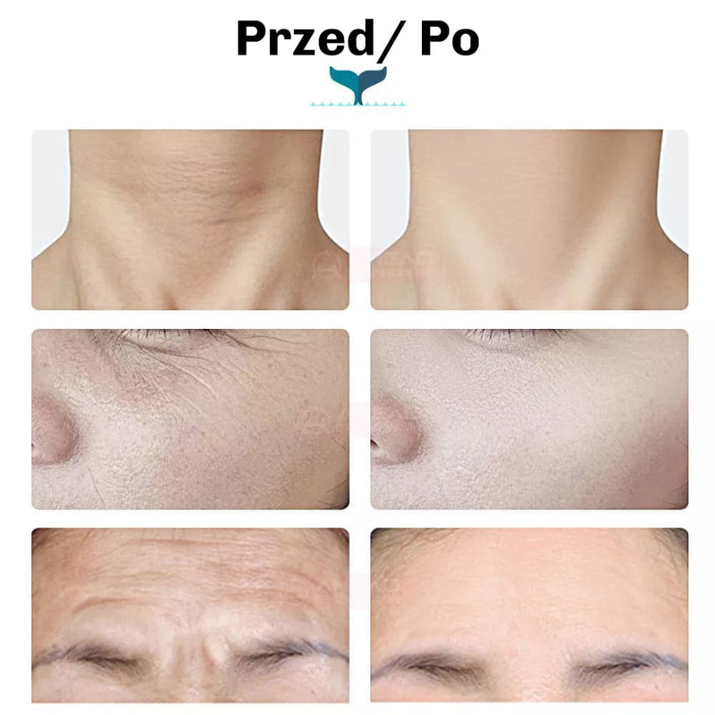 Przyspieszona regeneracja skory dzieki EMS