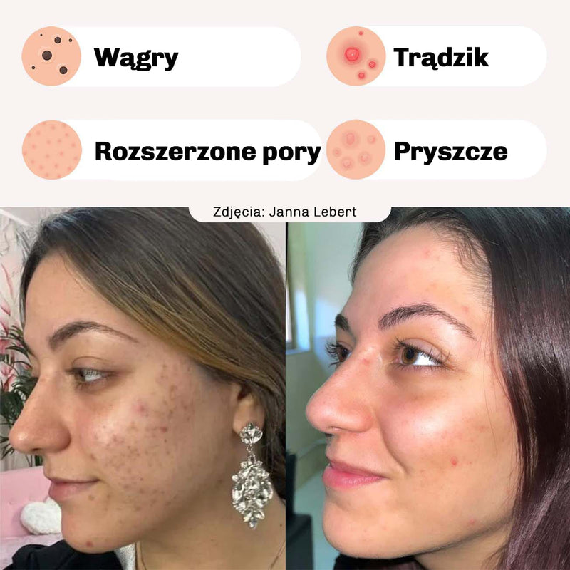 Oczyszczanie skory w 20 minut z natychmiastowym efektem