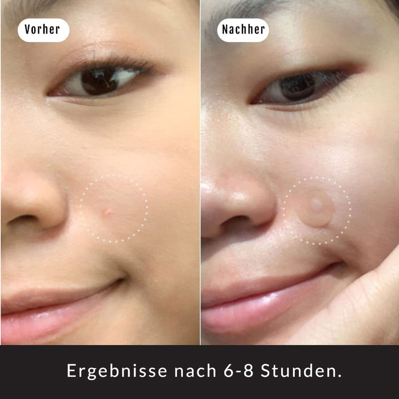 Ergebnis mit Silky Planet Anti-Pickel Pflaster – klarere Haut, kleinere Poren und weniger neue Pickelbildung dank gezielter Pflege.