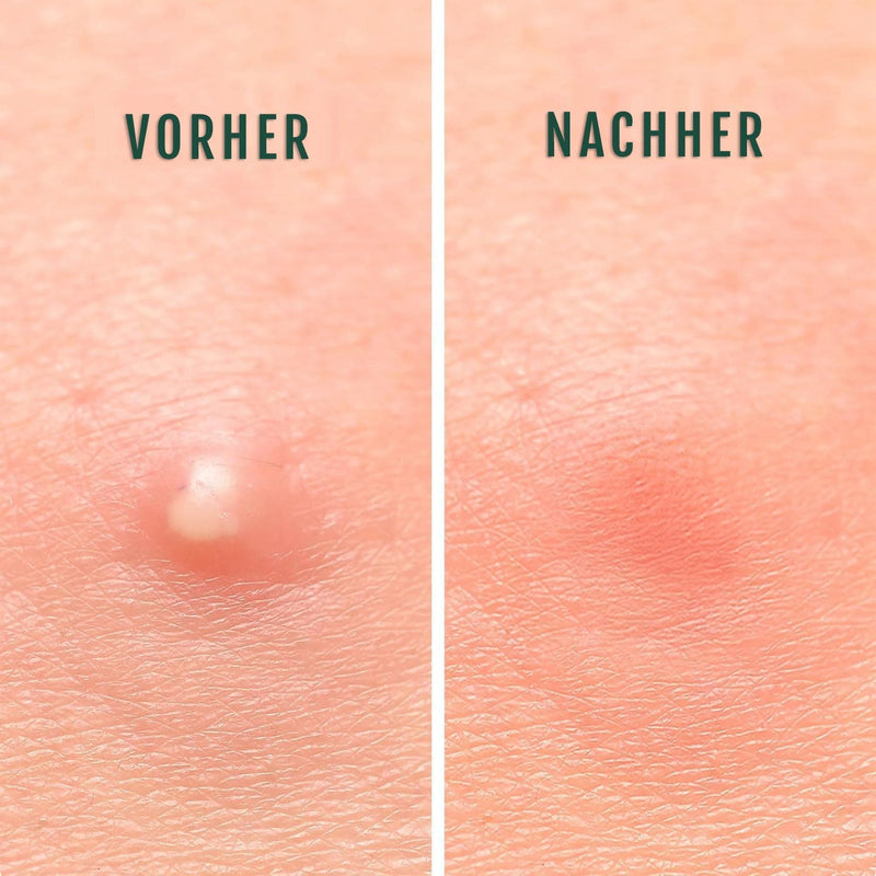 Vorher-Nachher Vergleich mit Silky Planet Anti-Pickel Pflaster – sichtbare Reduktion von Rötung, Schwellung und unangenehmen Pickeln.