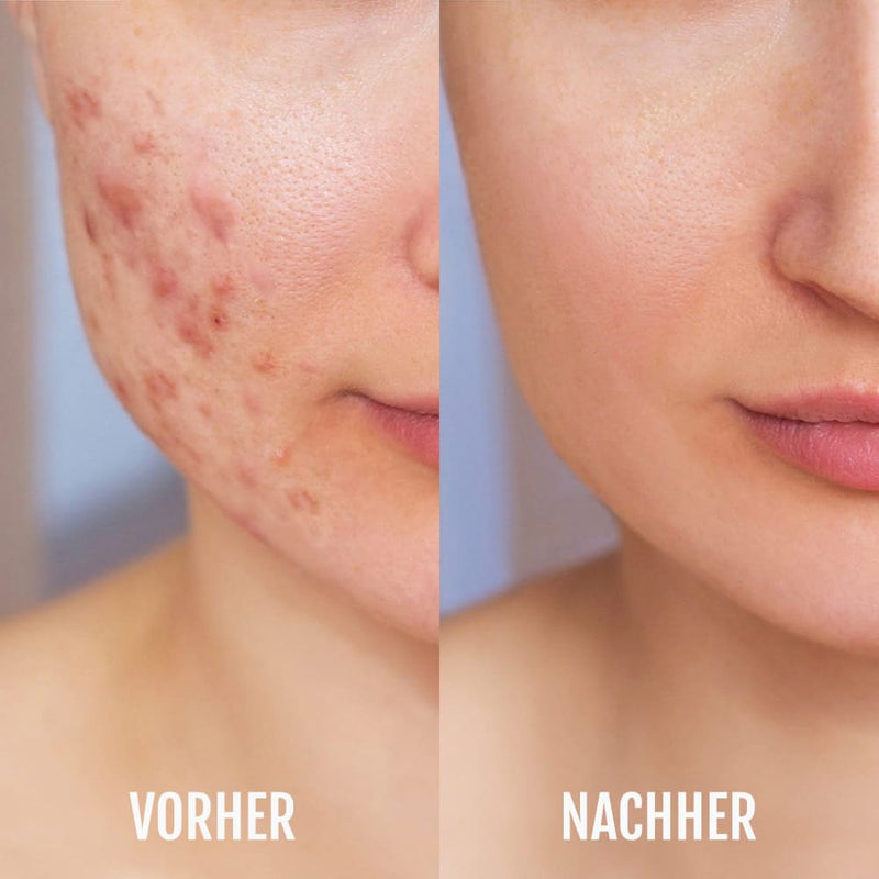 Vorher-Nachher Vergleich – Haut vor und nach Anwendung des Silky Planet DermaClear Geräts zur Aknebehandlung.