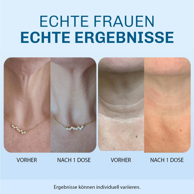 Vorher-Nachher Vergleich: Halsbereich vor Nutzung der Silky Planet Hals-Falten Lifting Creme und nach mehrwöchiger Anwendung – sichtbare Verbesserung.