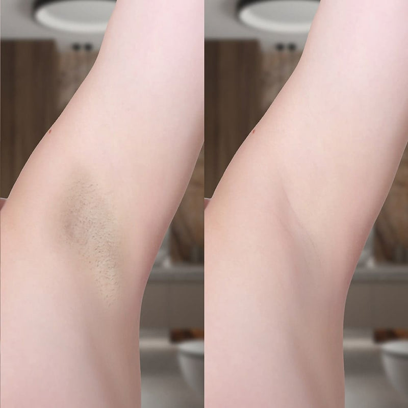 Vorher-Nachher Ergebnis mit dem Silky Planet IPL Haarentferner Glamour Expert – sichtbar reduzierter Haarwuchs nach wenigen Anwendungen.