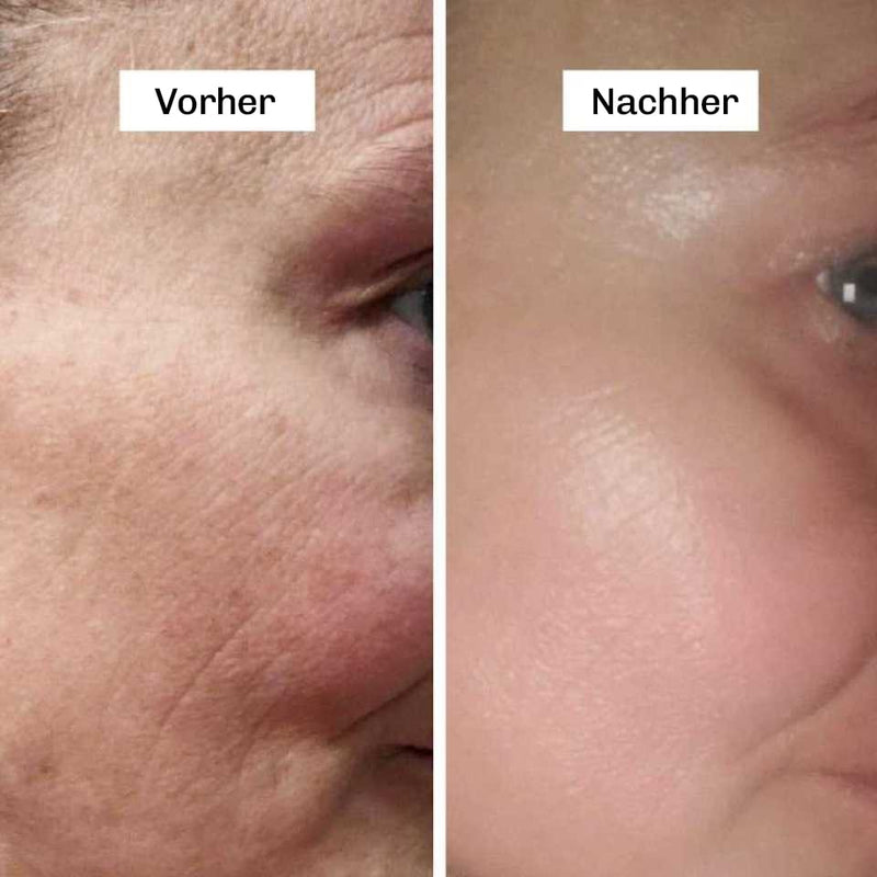 Vorher-Nachher Effekt mit der Silky Planet Kollagen Lifting Creme – sichtbare Reduktion von Fältchen und mehr Hautelastizität in 7 Tagen.