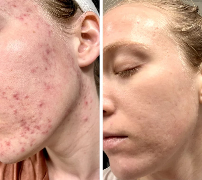 Vorher-Nachher-Vergleich mit der Silky Planet LED Lichttherapie Gesichtsmaske – bessere Hauttextur und reduzierte Alterszeichen nach regelmäßiger Anwendung.