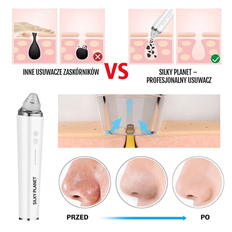 Urzadzenie z powiekszeniem 20x do dokladnego oczyszczania porow