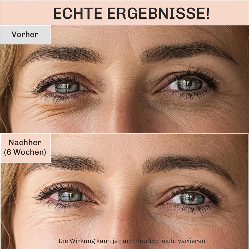 Vorher-Nachher: sichtbar glattere Augenpartie, gemilderte Fältchen und weniger Schwellungen.