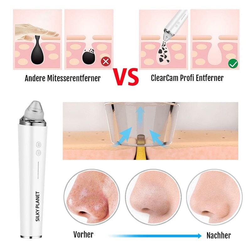 Mitesser Sauger mit WLAN Funktion fuer moderne Hautpflege zuhause