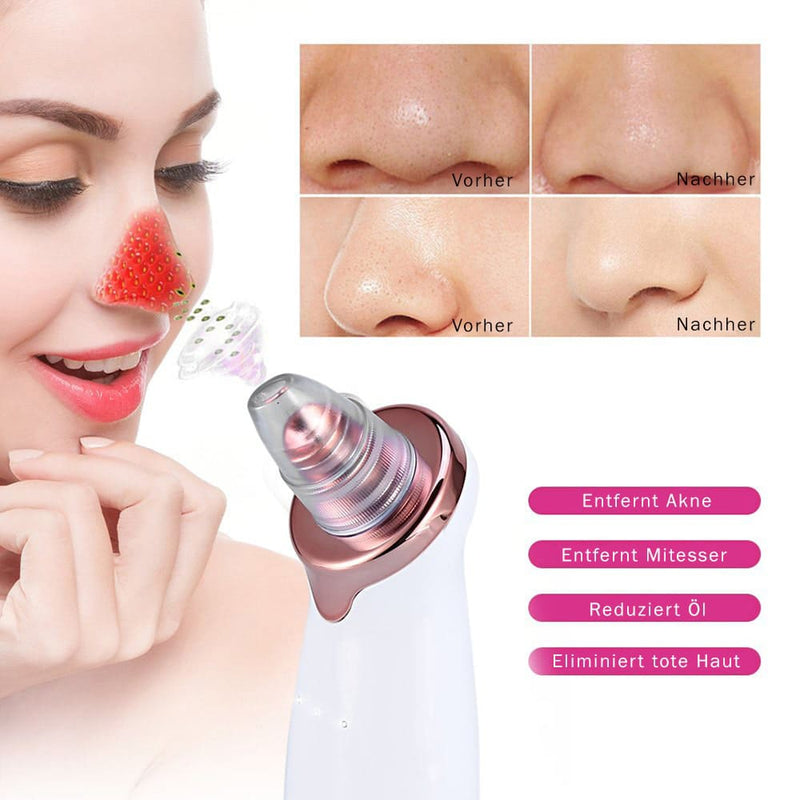 Vorher-Nachher: sichtbar verfeinerte Poren, weniger Mitesser und ein ebenmäßiger Teint